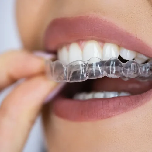 654b17f4a2fcfc932ebf32e7_sorriso-perfeito-invisalign-1200x1200-1