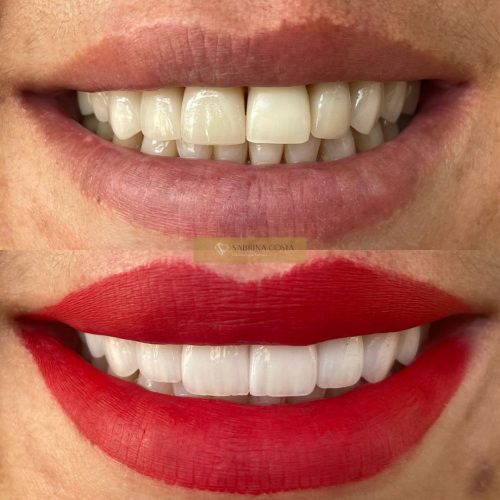 Implante dentário - criativo estático