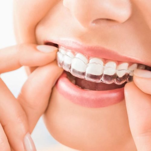 como-funciona-o-Invisalign-conheca-os-alinhadores-transparentes-scaled-1 Grande